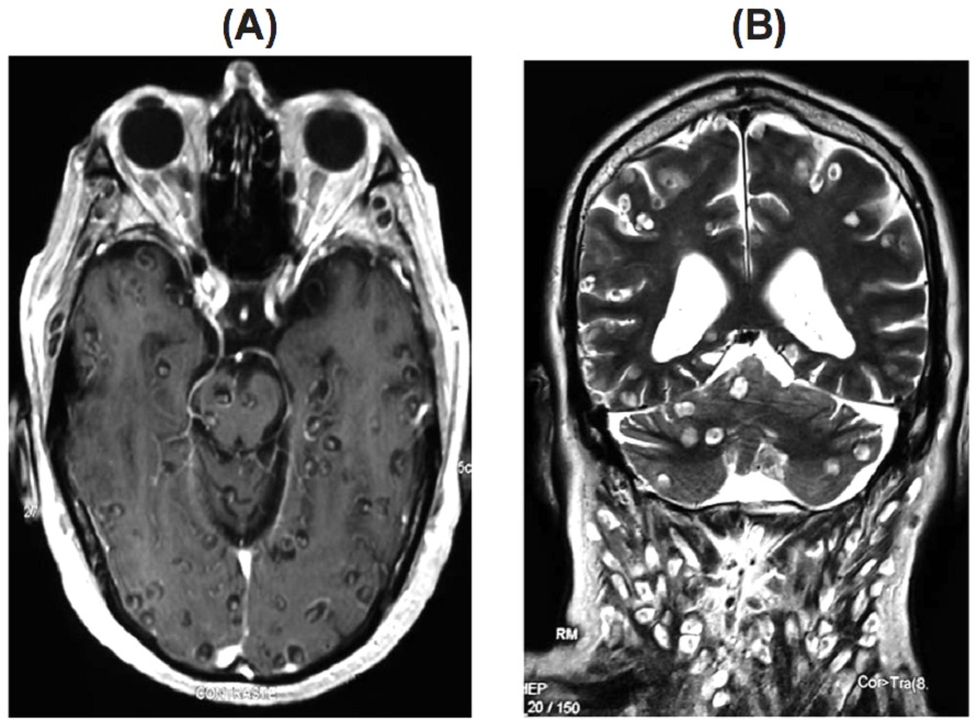 Carne de cerdo infectada con cisticercosis. Resonancia magntica donde se aprecian los mltiples quistes en el cerebro (Neurocisticercosis). 