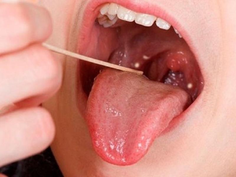 El Ministerio de Salud de Nacin, inform que en lo que va del ao, en el pas, incluida Tierra del Fuego, se confirmaron 118 casos producidos por la bacteria Streptococcus pyogenes.