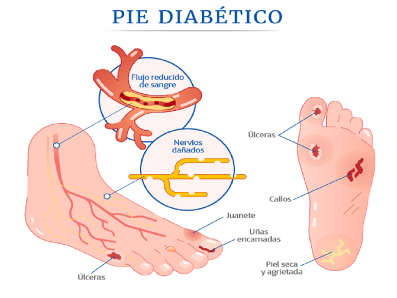 Las jornadas se desarrollarn del 11 al 14 de agosto desde las 10 horas en el Centro Municipal de Salud N 4. Estn dirigidas especficamente a personas con diagnstico de diabetes.