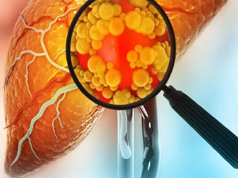 Cuando las c�lulas hep�ticas comienzan a almacenar demasiada grasa, el �rgano pierde eficiencia. En fases iniciales puede no generar molestias, pero con el tiempo pueden aparecer inflamaci�n persistente y lesiones permanentes.
